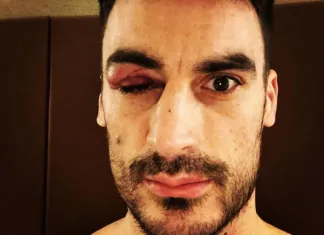 Фото: Капитан сборной Казахстана показал последствия травмы, которую он получил в игре против Беларуси